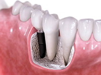 Dantų implantacija