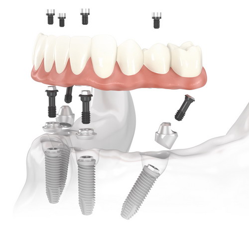 Neodent implantai ir „All-on-4“ metodika