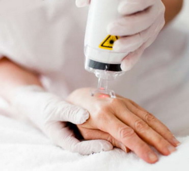 Karpų šalinimas dermatologijos klinikoje